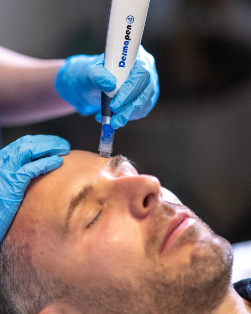Skin Needling